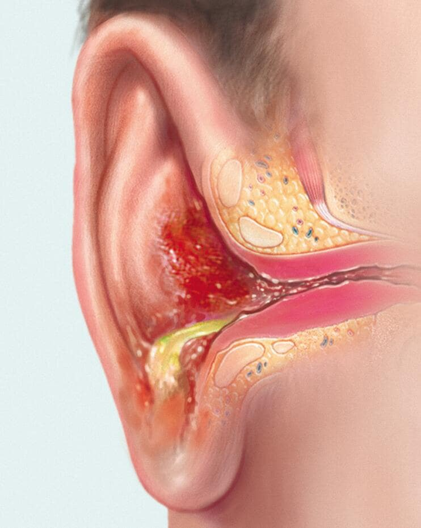 <ul><li><p>Inflammation of the outer ear / external auditory canal caused by bacteria or fungus. Also known as “swimmer’s ear.”</p></li><li><p>Symptoms include <u>ear canal swelling</u>, <u>ear pain with tragus palpation or pulling on the ear superiorly / inferiorly</u>, <u>itching (more common with fungal etiology)</u>, <u>otorrhea</u></p></li><li><p><strong>Acute Bacterial Otitis Externa</strong> is the most common OE seen by PCPs</p></li><li><p>vinegar can prevent</p></li></ul><p></p>
