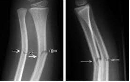 <p><strong>partial thickness fracture of one cortex, a pediatric fracture &lt;10yo </strong><br><span>-</span><strong>forearm (most common)</strong><span>, can occur in other long bones, tibia/fibula</span><br><em>MOI: </em><strong>FOOSH</strong><span> </span><strong>injury</strong><span> is most common cause</span><br><br><span>S/S: loss of motion, pain to palpation, +/- ecchymosis, deformity</span><br><br><span>Dx: </span><strong>XRAY (first line)</strong><span> shows ‘bowing’ of bones</span><br><span>Tx: </span><strong>conservative</strong><span>: depending on angulation, ± reduction with casting</span></p>