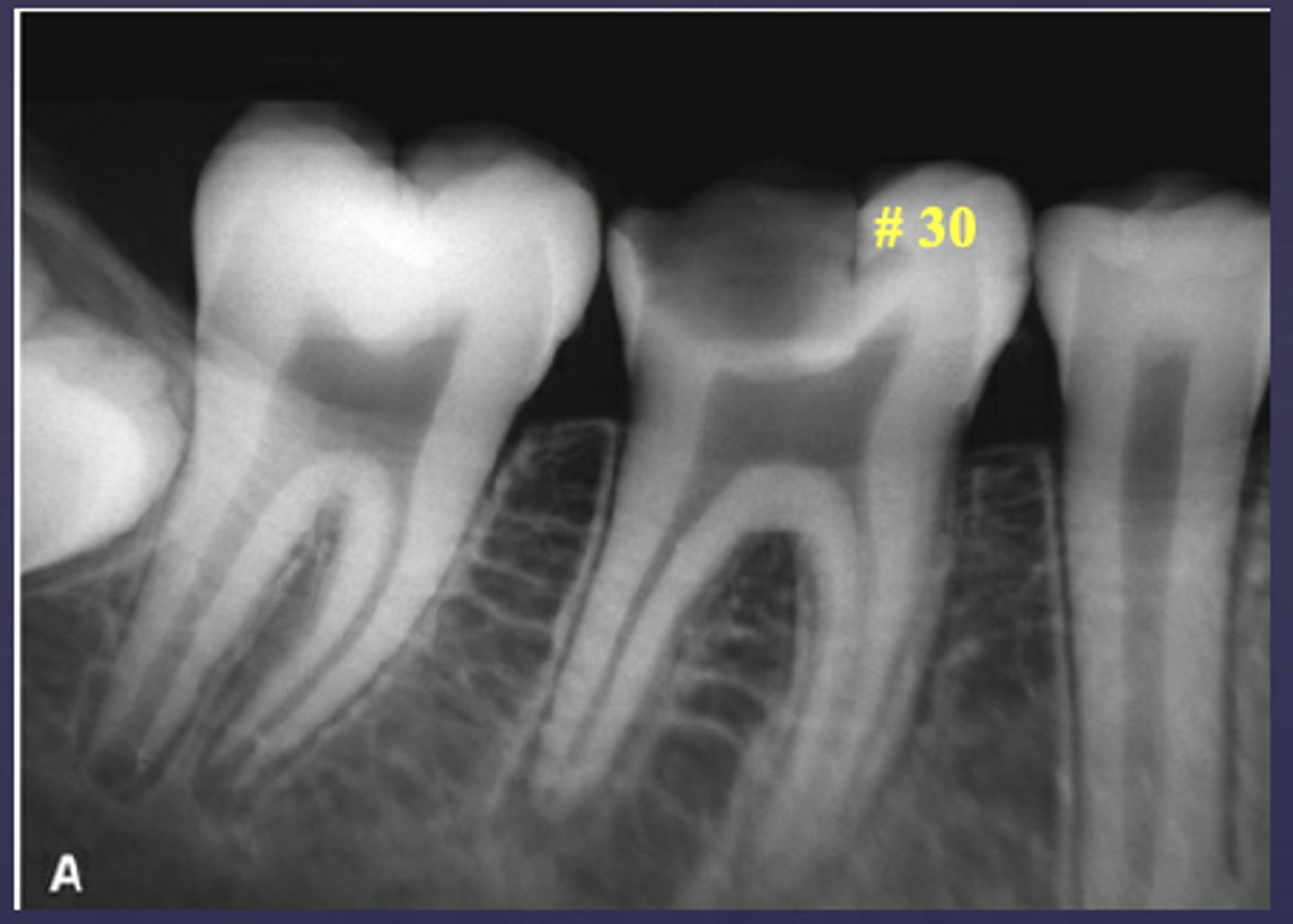 <p>What condition is present in this radiograph?</p>