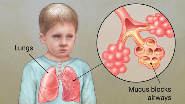 <p><strong>A physician is providing care for a child who has a diagnosis of cystic fibrosis (CF). Place the following events in the etiology of CF in ascending chronological order. Use all the options.</strong></p><p>A) Airway obstruction</p><p>B) Recurrent pulmonary infections</p><p>C) Impaired Cl– transport</p><p>D) Decreased water content of mucociliary blanket</p><p>E) Increased Na+ absorption </p>