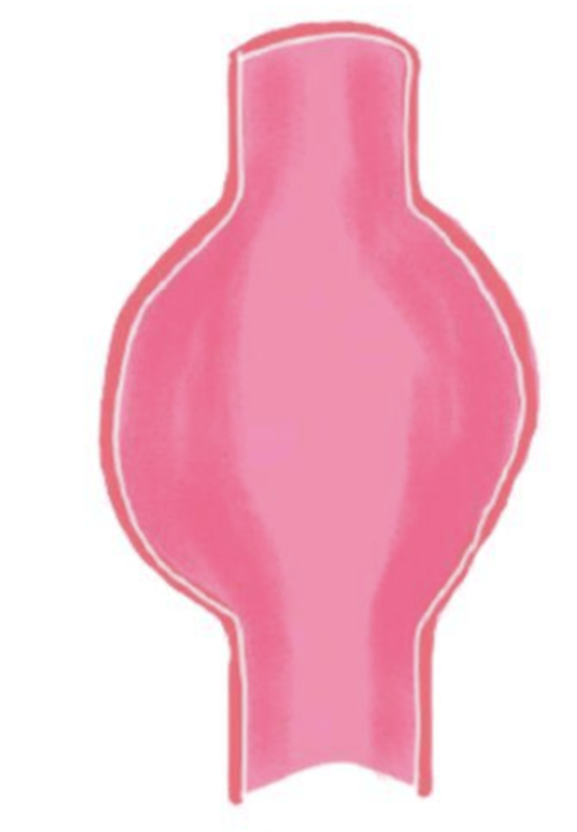 <p>weakening of all 3 layers and complete stretching of the vessel wall</p><p>outpouching around the entire circumference of the aorta</p>