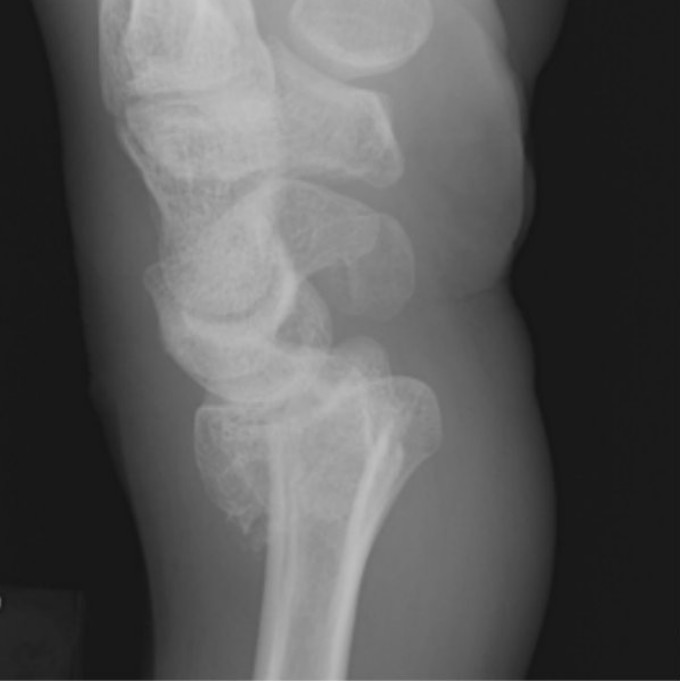 <p>Which fracture is this?</p>