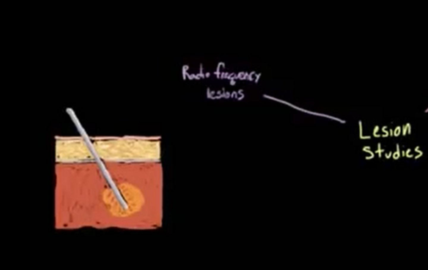 <p>(D) Radio Frequency Lesions</p>