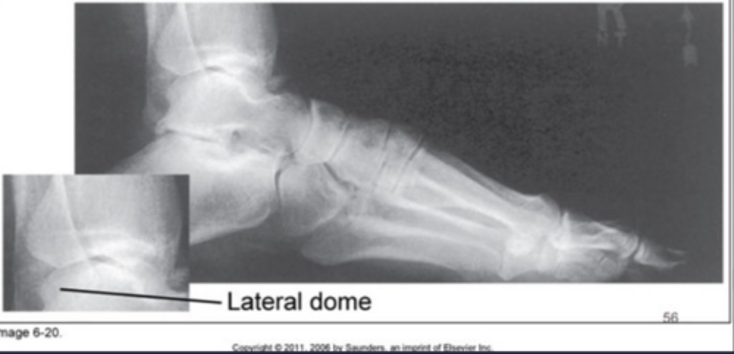 <p>Heel elevated</p>