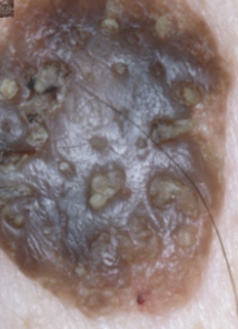 <p><span>benign epidermal growth, “stuck on” appearance</span></p>