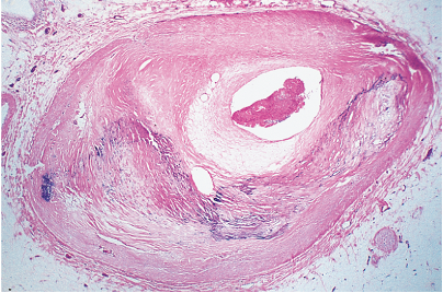 A 58-year-old woman has experienced chest pain at rest for the past year. On physical examination, her pulse is 80/min and irregular. The figure shows the microscopic appearance representative of her left anterior descending artery. Which of the following laboratory findings is most likely to be involved in the pathogenesis of the process illustrated?