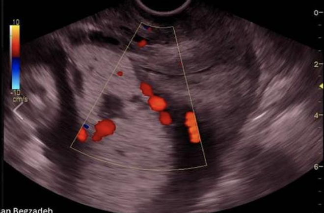 <p>which describes the findings </p><p>a) there is large amount of meconium funneled toward the cervix</p><p>b) a chorioangioma has formed at the internal os</p><p>c) the maternal bladder is too full accurately </p><p>d) complete placenta previa </p>