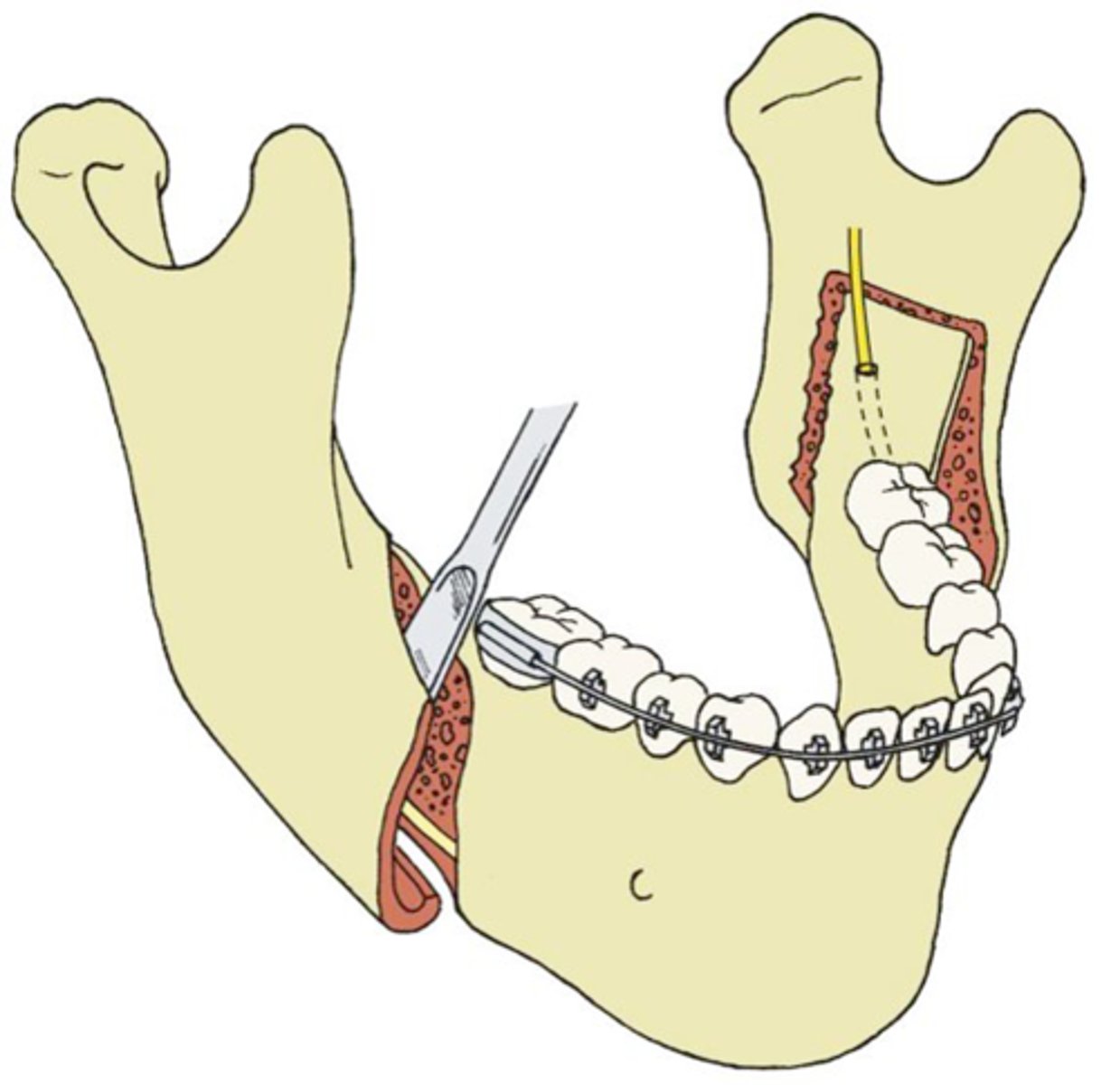 <p>- used in orthognathic surgery to correct jaw deformities by splitting the lower jawbone (mandible) in a sagittal plane and repositioning the tooth-bearing segment.</p><p>- This is typically done to move the lower jaw forward or backward,</p><p>- often a part of a bilateral procedure (BSSO) used to treat conditions like mandibular prognathism.</p><p>- Post-surgery recovery often involves swelling, numbness, and a soft diet for several weeks</p>