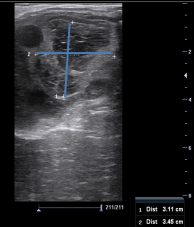<p>AKP store husdyr blok 1 2024</p><p>En hoppe er blevet scannet med henblik på insemination. Billedet viser venstre ovarie. De blå markeringer angiver målene på en struktur i ovariet på 35 x 31 mm. To dage før var der en follikel på 38 mm. Hvilken struktur ses på ovariet?</p><p>1 Granulosa-theca celle tumor </p><p>2 Follikelcyste </p><p>3 Luteincyste </p><p>4 Corpus hæmorrhagicum</p>
