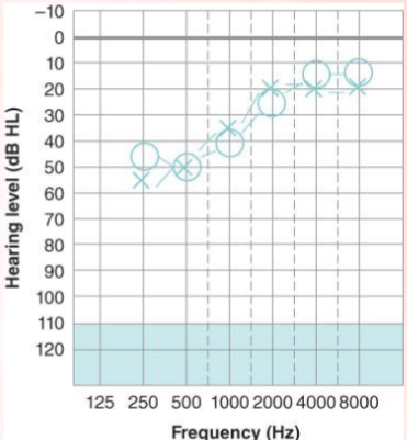 <p>What is a reverse curve pattern of hearing loss?</p>