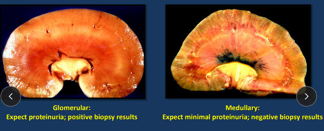 <ul><li><p><span style="background-color: transparent;"><strong>Path</strong>: </span><span style="background-color: transparent; color: blue;">β-pleated sheet deposits</span></p><ul><li><p><span style="background-color: transparent;"><strong>Distribution: systemic (most common</strong>) > localized (pancreatic islet cells of cats)</span></p><ul><li><p><span style="background-color: transparent;"><strong><u>Cat are 100% medullary, 75% glomerular</u></strong></span></p></li></ul></li><li><p><span style="background-color: transparent;"><strong>Protein:</strong> AA, AL, ATTR, Aβ2M, AIAPP</span></p></li></ul></li><li><p><span style="background-color: transparent;"><strong>Et: <u>Reactive systemic dz, idiopathic, familial (dogs, cats)</u></strong></span></p><ul><li><p>chronic infectious and non-infectious inflammatory, neoplasia</p></li></ul></li><li><p><span style="background-color: transparent;"><strong>Sig: </strong>Mid age, </span><span style="background-color: transparent; color: blue;">Shar Pei (M), Beagle (G), FoxHound (G), Abyssinian (M), Siamese (M), Oriental (M)</span></p><ul><li><p><strong>Glomerular > Medullary</strong> - dogs except shar pei</p></li><li><p><strong>Medullary > Glomerular</strong> - cats including Abyssinian</p><ul><li><p><u>Lugol’s iodine</u> can be used to presumptively identify</p></li></ul></li></ul></li><li><p><span style="background-color: transparent;"><strong>Cs: </strong>CKD,<strong> recurrent fever</strong>,<strong> tibotarsal swollen joints(shar pei)</strong>, <strong>liver rupture, hemoabdomen</strong>, poor coat, small odd kidneys, nephrotic syndrome, thromboembolism,<strong> retinal hemorrhage/detachment - sudden blindness (Ab. cats</strong>)</span></p><ul><li><p><span style="background-color: transparent;"><strong><u>Cs from kidney involvement + CKD:</u></strong> except shar pei and cats which is liver rupture, hemoabdomen</span></p></li></ul></li><li><p><span style="background-color: transparent;"><strong>Dt:</strong> </span><span style="background-color: transparent; color: blue;">proteinuria/high UPC >10,</span><span style="background-color: transparent;"> ↑ cholesterol, ↓ albumin, Azotemia, ↑ P, <strong><u>microalbuminuria (unclear Px factor, vascular dz)</u></strong>, </span><span style="background-color: transparent; color: blue;"><strong>biopsy definitive </strong></span><span style="background-color: transparent;"><strong>(Renal cortical tissue, IH, EM</strong>, IF, Lugos iodine)</span></p></li><li><p><span style="background-color: transparent;"><strong>Tx: <u>none to be benifical</u></strong>, </span><span style="background-color: transparent; color: blue;">relentless Px is the rule</span></p></li></ul><img src="https://knowt-user-attachments.s3.amazonaws.com/7559ba6d-b238-4666-bee5-1694160ba2d5.png" data-width="50%" data-align="center" alt="Edema"><p></p>