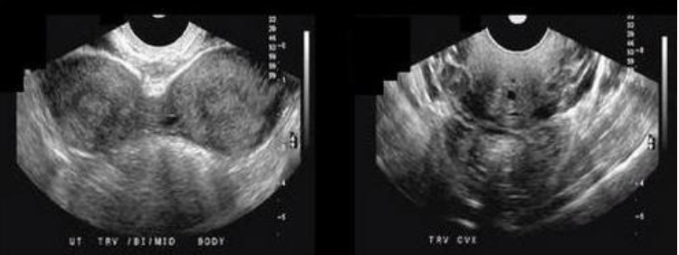 <p>which congenital abn is this</p><p>a) uterine subseptus</p><p>b) uterine bicornis bicollis</p><p>c) uterine arcuatus</p><p>d) uterine bicornis unicollis </p>