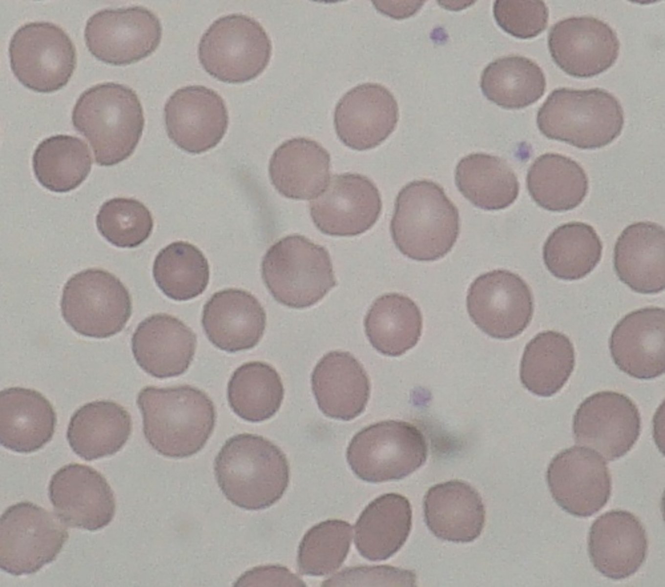 <p>Hereditary spherocytosis</p><p>Autoimmune hemolytic anaemia</p>