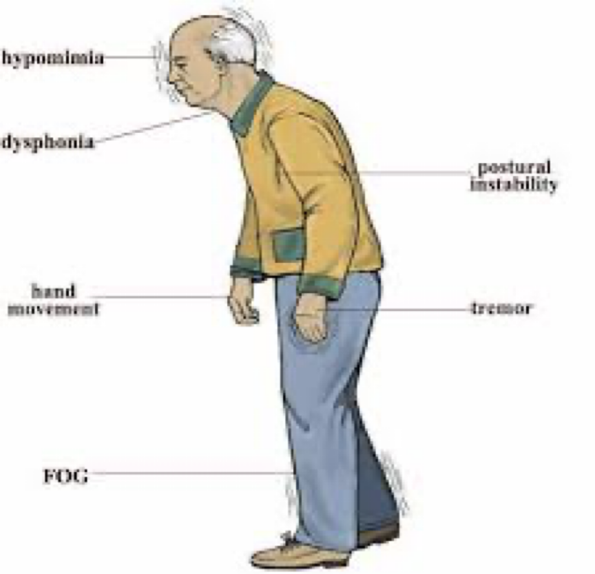 <ul><li><p>We don’t know.&nbsp;</p></li><li><p>There are currently no blood or laboratory tests to diagnose nongenetic cases of Parkinson's disease.</p><ul><li><p>Diagnosis is based on a person's medical history and a neurological examination.&nbsp;</p></li><li><p>this could change very soon…</p></li></ul></li></ul>