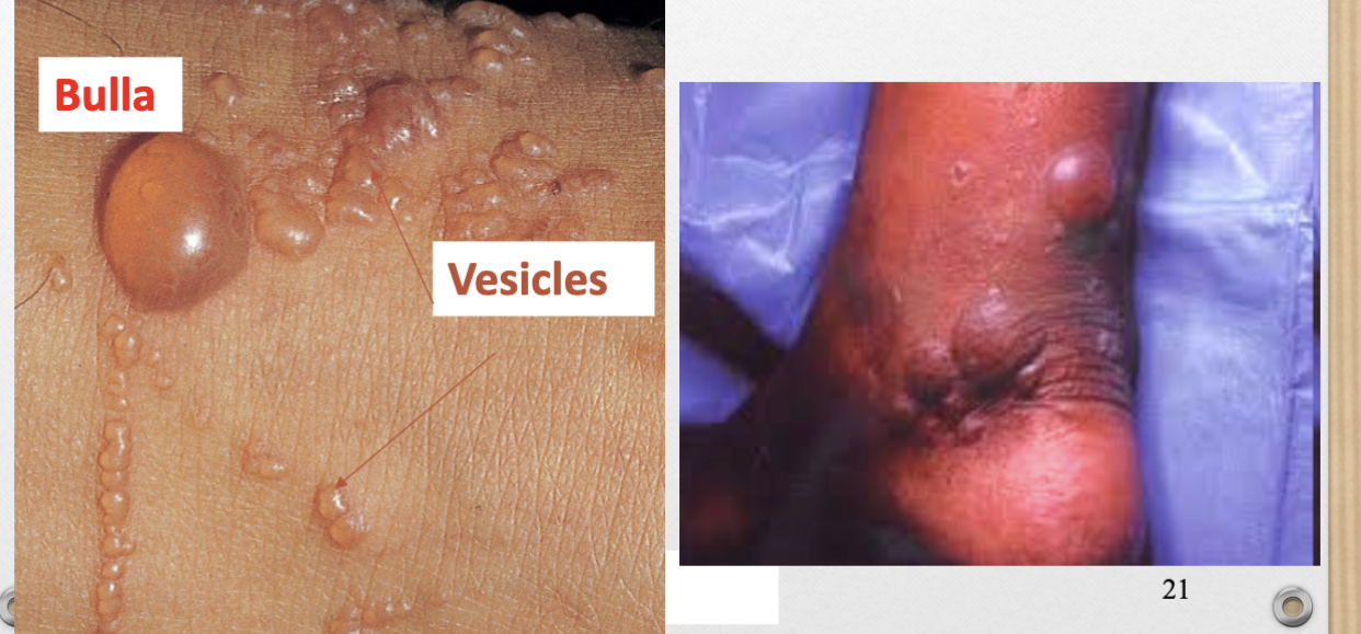 <p>ex. from burns </p>