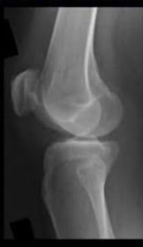 <p>Is the patient in true lateral with proper tube angle? Explain.</p>