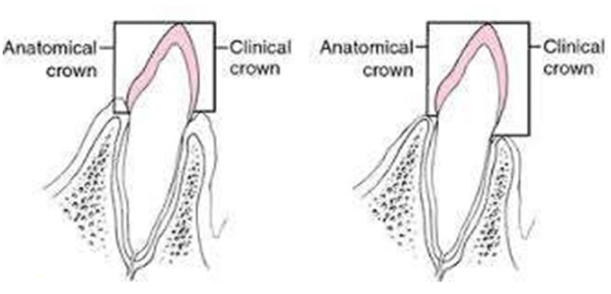 <p>Amount of tooth visible above the gum line, doesn’t recess</p><p>Anatomical crown minus 1.8mm</p>