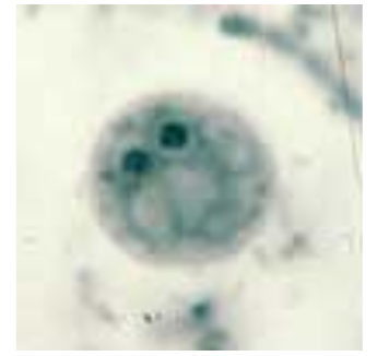 <p><strong>Laboratory diagnosis </strong>- detection of bi-nucleated trophozoites; fragmented karyosomes consisting of 4 to 8 granules of chromatin.</p><p><strong>Diagnostic stage</strong> - the trophozoite in feces. There is no cyst stage.</p><p><strong>Morphology </strong>- 1 or 2 nuclei, with little or no peripheral chromatin; karyosome is divided into 4 to 8 distinct granules.</p><p>May rarely ingest rbc’s.</p><p><strong>Pathology </strong>- infection is usually asymptomatic; can be associated with diarrhea, anorexia, abdominal pain.</p><p><strong>Association </strong>with pinworm - the organism may be transmitted from host to host within the egg of Enterobius vermicularis. </p><p><strong>Distribution </strong>- worldwide, there is a 1% to 20% prevalence.</p>