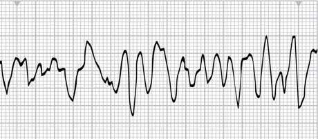 Coarse V-Fib