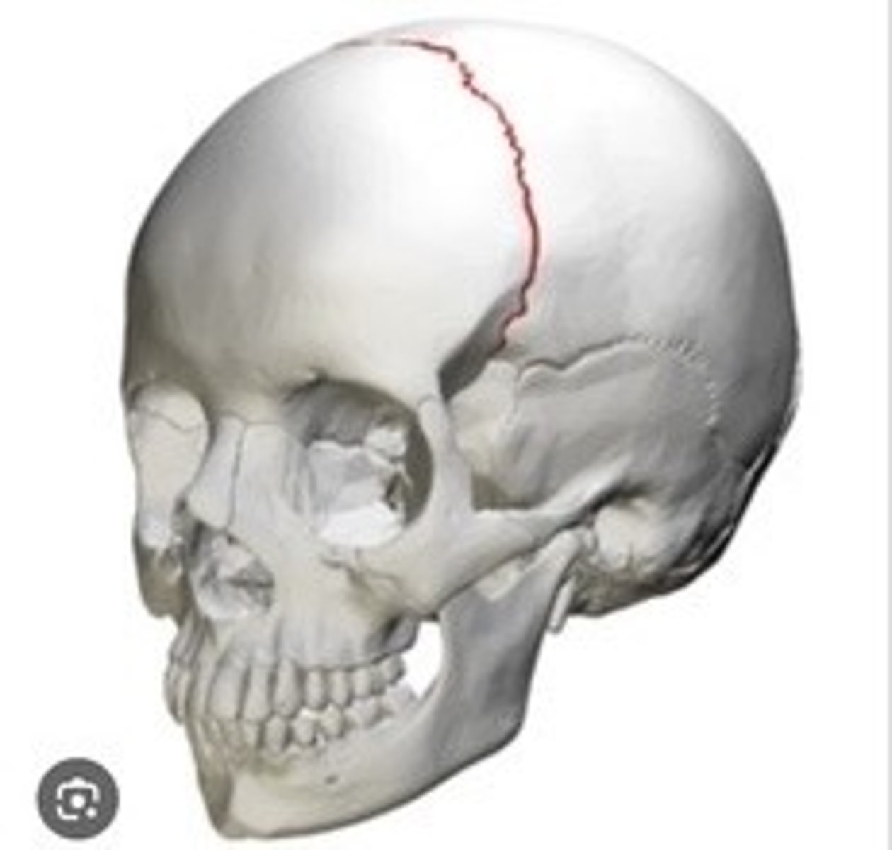 <p>Suture between frontal and parietal bones.</p>