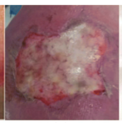 <p>Deep partial thickness</p><p><em>Epidermis and papillary dermis with damage to the reticular layer</em></p>