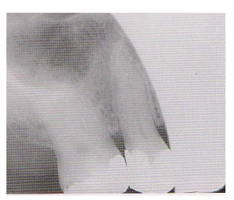 <ul><li><p>A clear unexposed crescent appears on the film</p><ul><li><p>Reason: PID was not properly aligned with the film holder and the xray beam did not expose the entire film. </p></li></ul></li><li><p>Fix: Ensure central ray is centered over the film </p></li></ul><p></p>