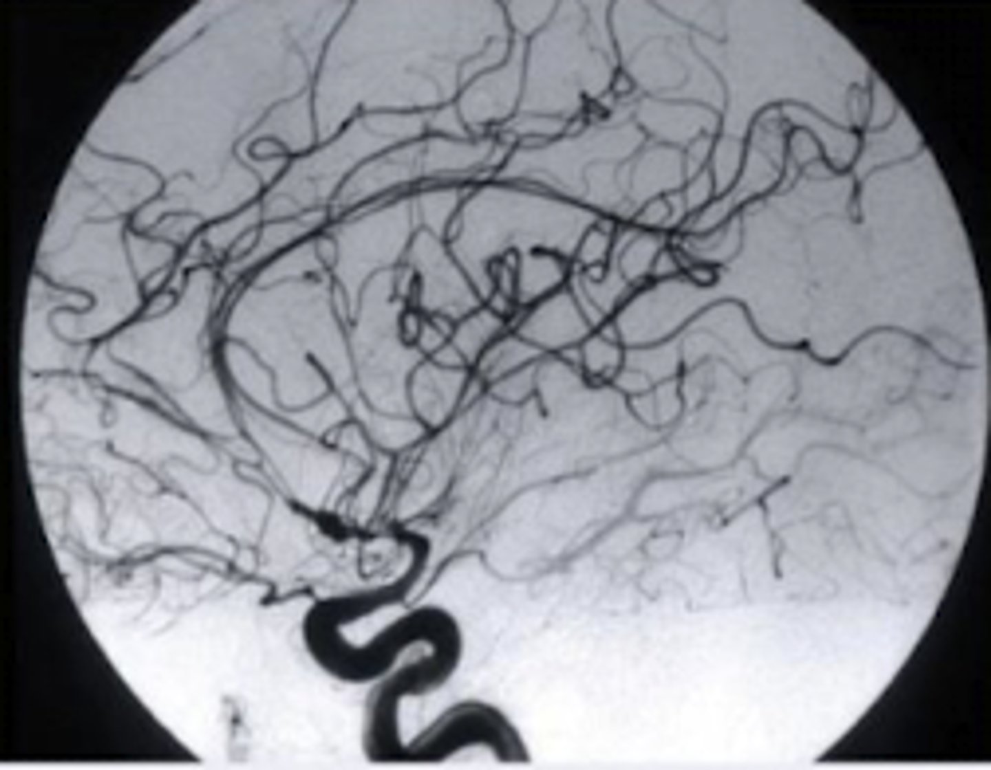 <p>technique used in IR to clearly visualize blood vessels in a bony or dense soft tissue environment - removes bones</p>