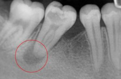 <ul><li><p>Espacio de ligamento periodontal ensanchado</p></li><li><p>Pérdida gradual de la nitidez del hueso alveolar adyacente</p></li><li><p>Rarefacción difusa en hueso alveolar</p></li><li><p>Pérdida de definición del patrón trabecular y aumento de radiotransparencia</p></li></ul><p></p>