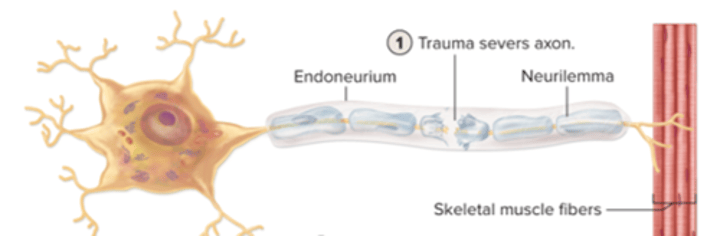 <p>axon severed by trauma</p>