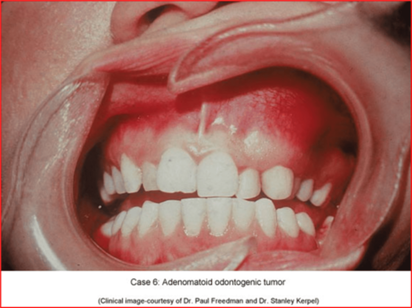 <p>• asymptomatic</p><p>• can be present with localized swelling</p>