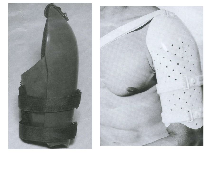<p>Circumferential and clam-shell style humeral fx bracing</p>