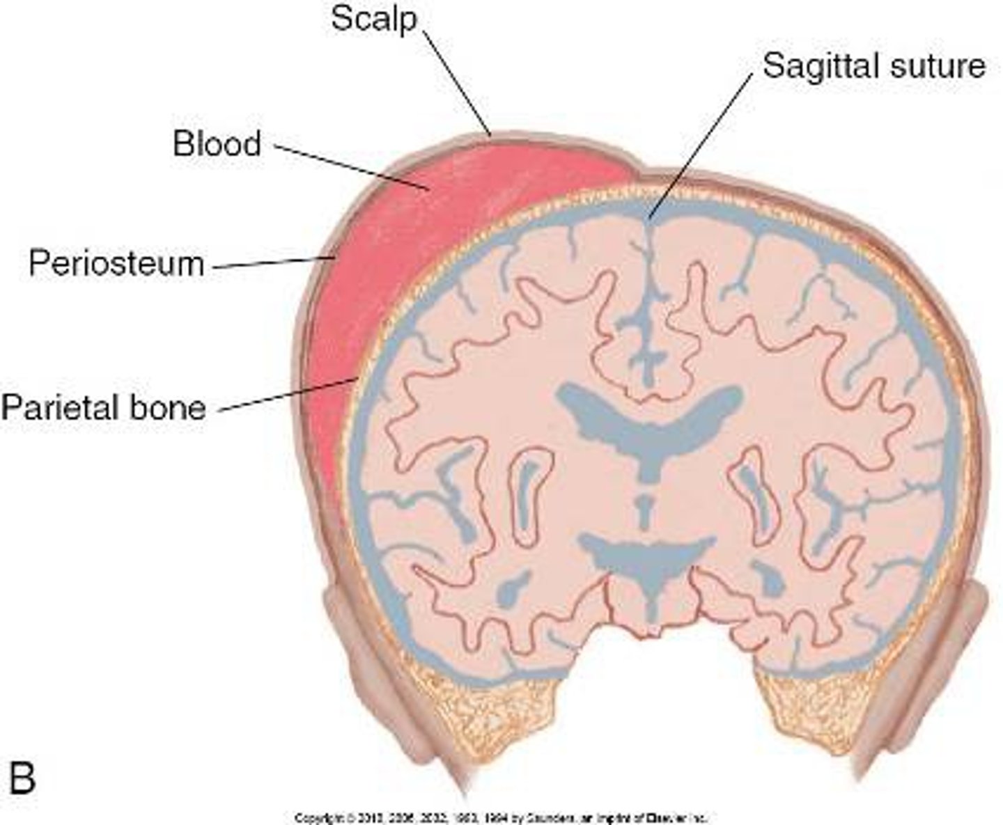 <p>Ans: (B)</p><p>The increased bilirubin levels are caused by the bruising and cephalhematoma secondary to free circulating bilirubin from the reabsorbed blood that had been displaced. Pathologic jaundice is evident in the first 24 hours of life while breast milk jaundice is seen after a week.</p>