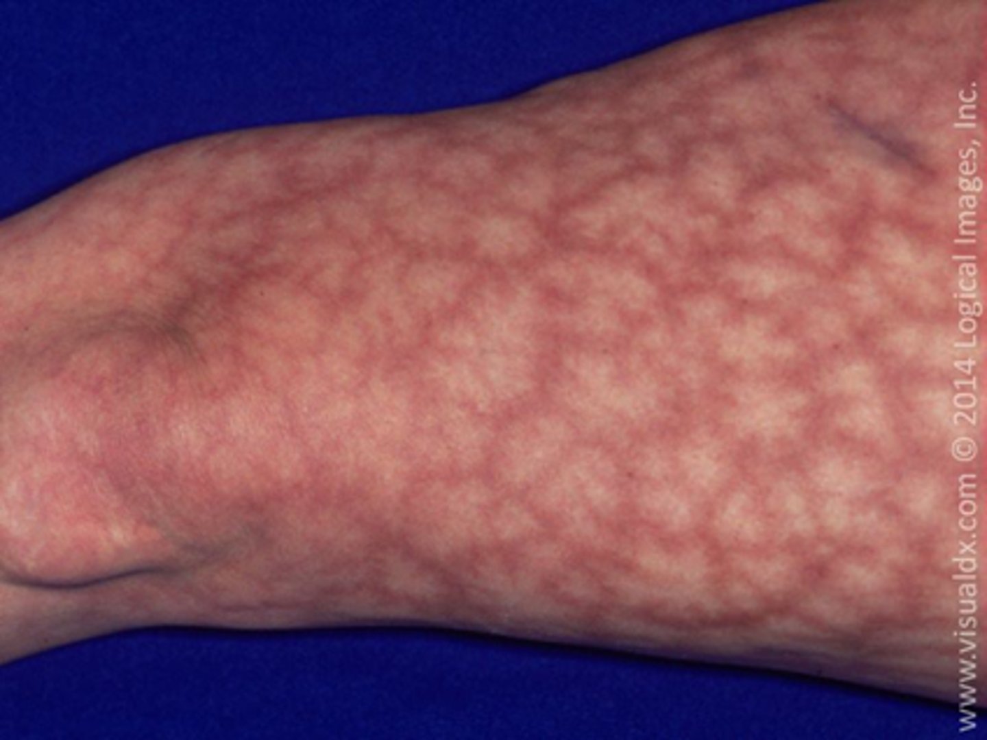 <p>diagnose this:</p><p>starburst pattern usually confined to buttock and lower extremities</p>