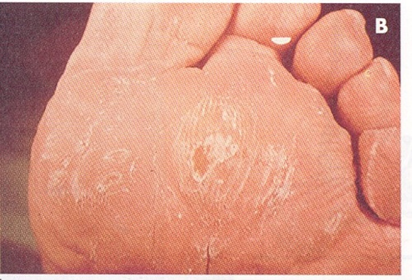 <p>extension at the metatarsophalangeal (MTP) joints</p>