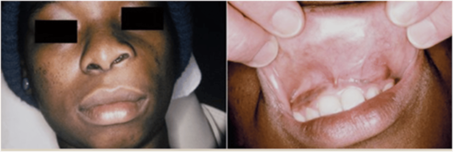 <p>• elevation - ala of nose (nasolabial groove area)</p><p>• can cause resorption of bone if large</p>