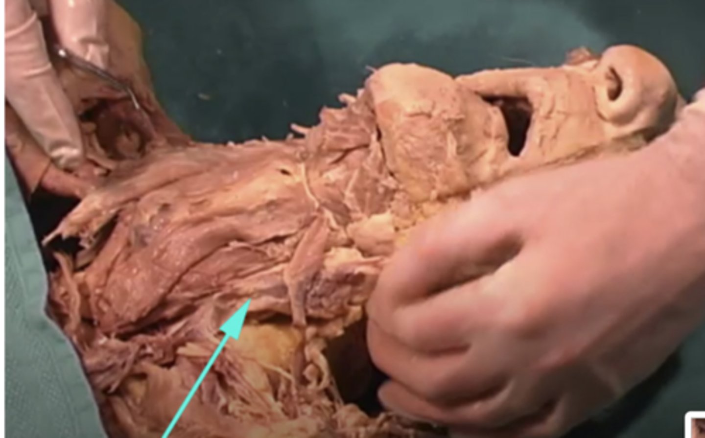 <p>What is the name of the structure as indicated by the arrow?</p><p>-carotid vein</p><p>-internal jugular vein</p><p>-internal jugular artery</p><p>-carotid artery</p>