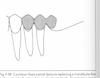 <ul><li><p>they replace only one tooth but have at least two abutments </p></li></ul><p></p>