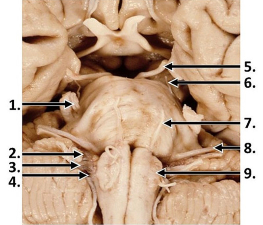 <p>PI: a lesion of which of the following cranial nerves results in diplopia with an ipsilateral ptosis, down and out eye, and mydriasis?</p>