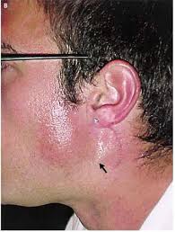 <p>Frey’s syndrome </p>