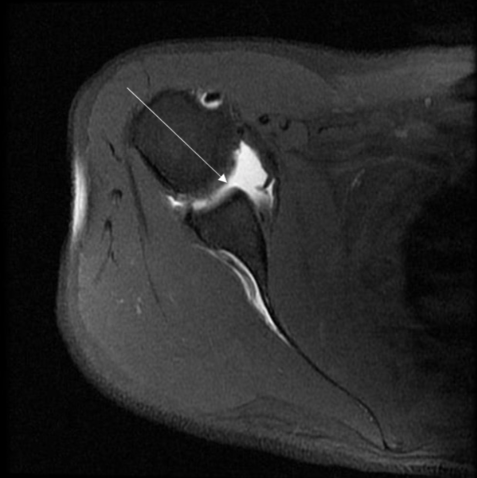 <p>Describe the pathology indicated by the arrow (Ax T1 FS - arthrogram). </p>
