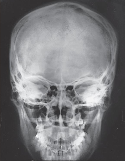 <ul><li><p>shows the same as PA and PA axial projections</p></li><li><p>evidence of proper collimation</p></li><li><p>entire cranial perimeter showing three tables of squamous bone</p></li><li><p>no rotation:</p><ul><li><p>equal distance from lateral borders of skull to lateral border of orbits</p></li><li><p>symmetric petrous ridges</p></li></ul></li><li><p>anatomy is more magnified</p></li></ul><p></p>