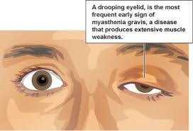 <p>An autoimmune neuromuscular junction (NMJ) disorder with unknown cause. Symptoms: weakness in eye muscles can lead to double vision, drooping eyelids, and difficulty focusing. </p>