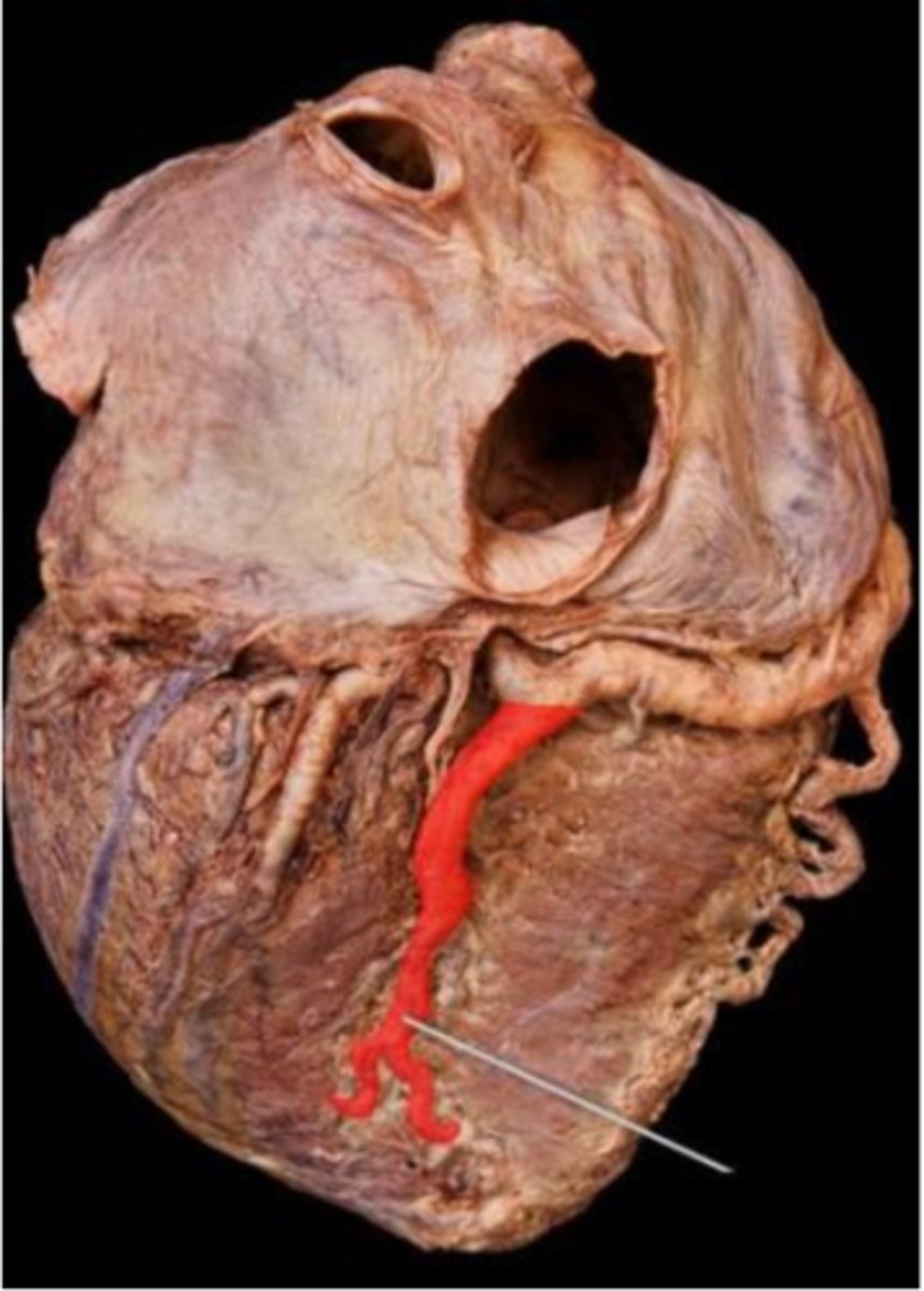 <p>posterior interventricular artery</p>