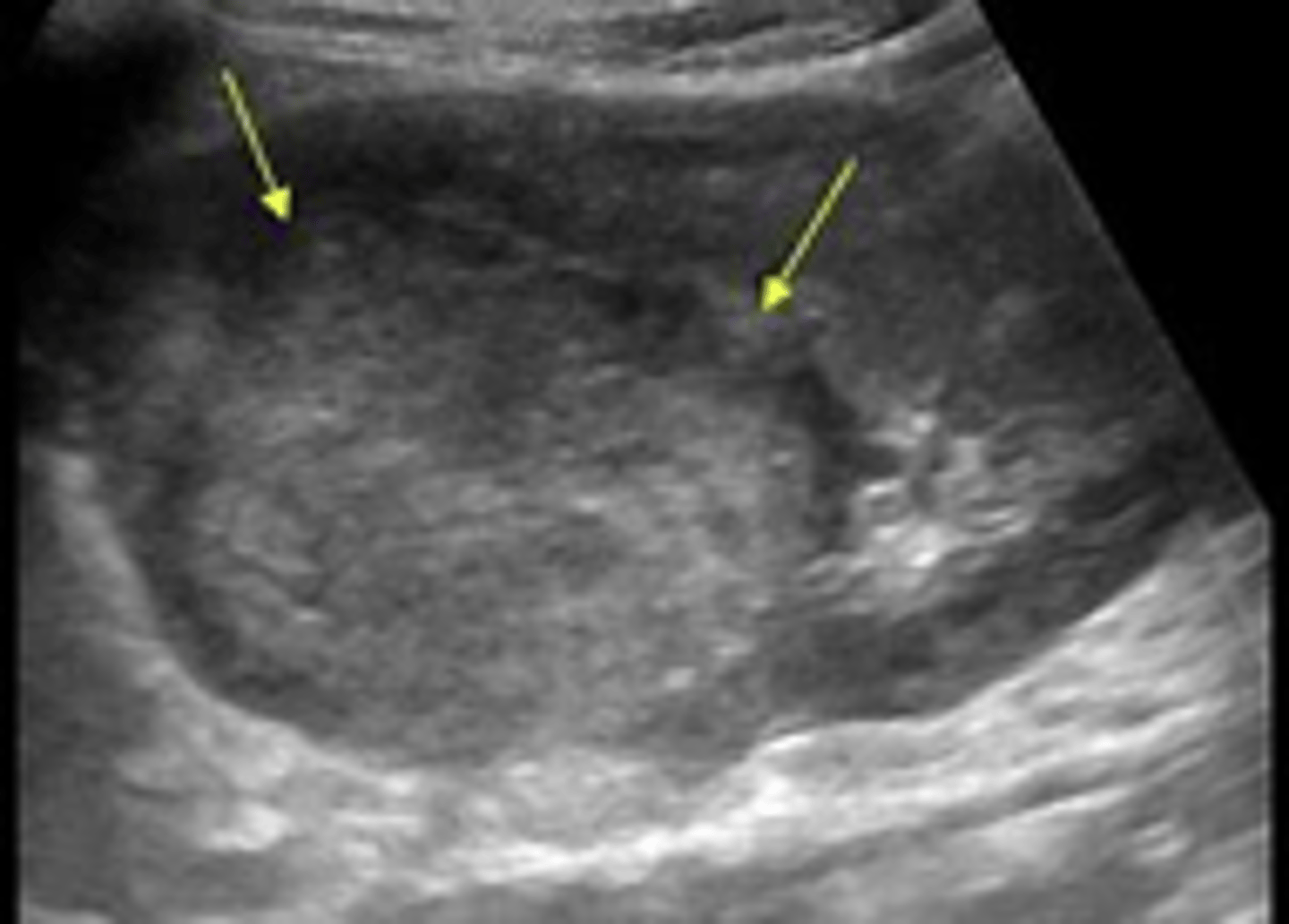 <p>Aka Wilms tumor</p><p>1. Its a pediatric patient</p><p>2. Its deadly and can be treated (cancerous)</p>