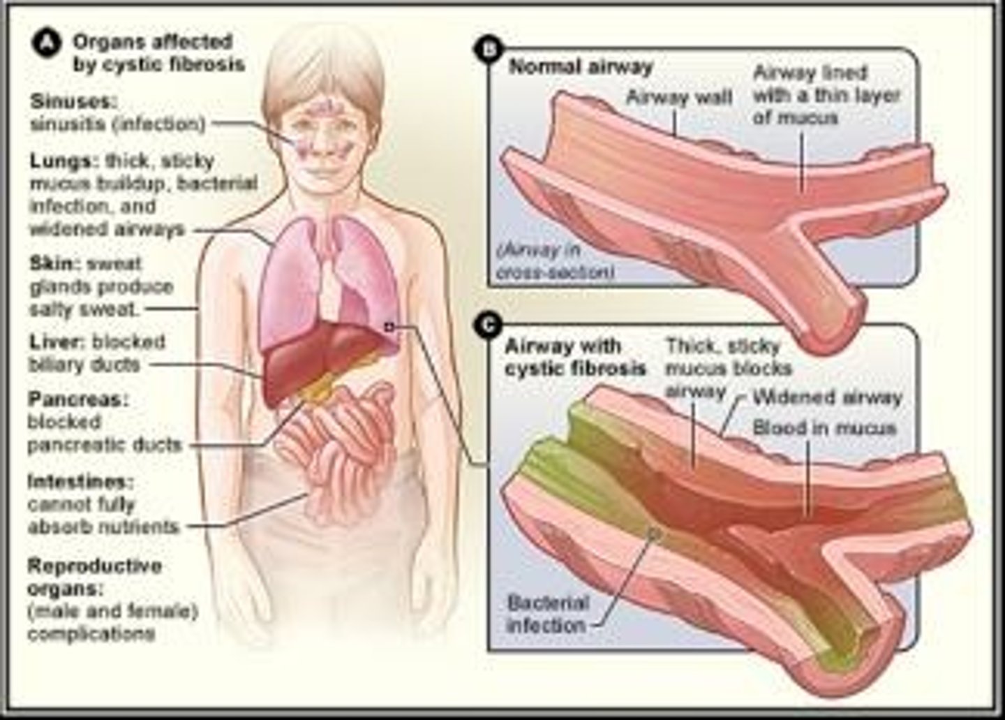 <p>• Progressive lung damage</p><p>• Delayed growth</p><p>- Failure to gain weight normally during childhood</p><p>- Excessive appetite but poor weight gain</p><p>• Salty-tasting skin</p><p>- High concentration of sodium &amp; chloride in sweat</p><p>• Persistent coughing, wheezing, pneumonia</p><p>• Production of abnormally thick mucus</p>