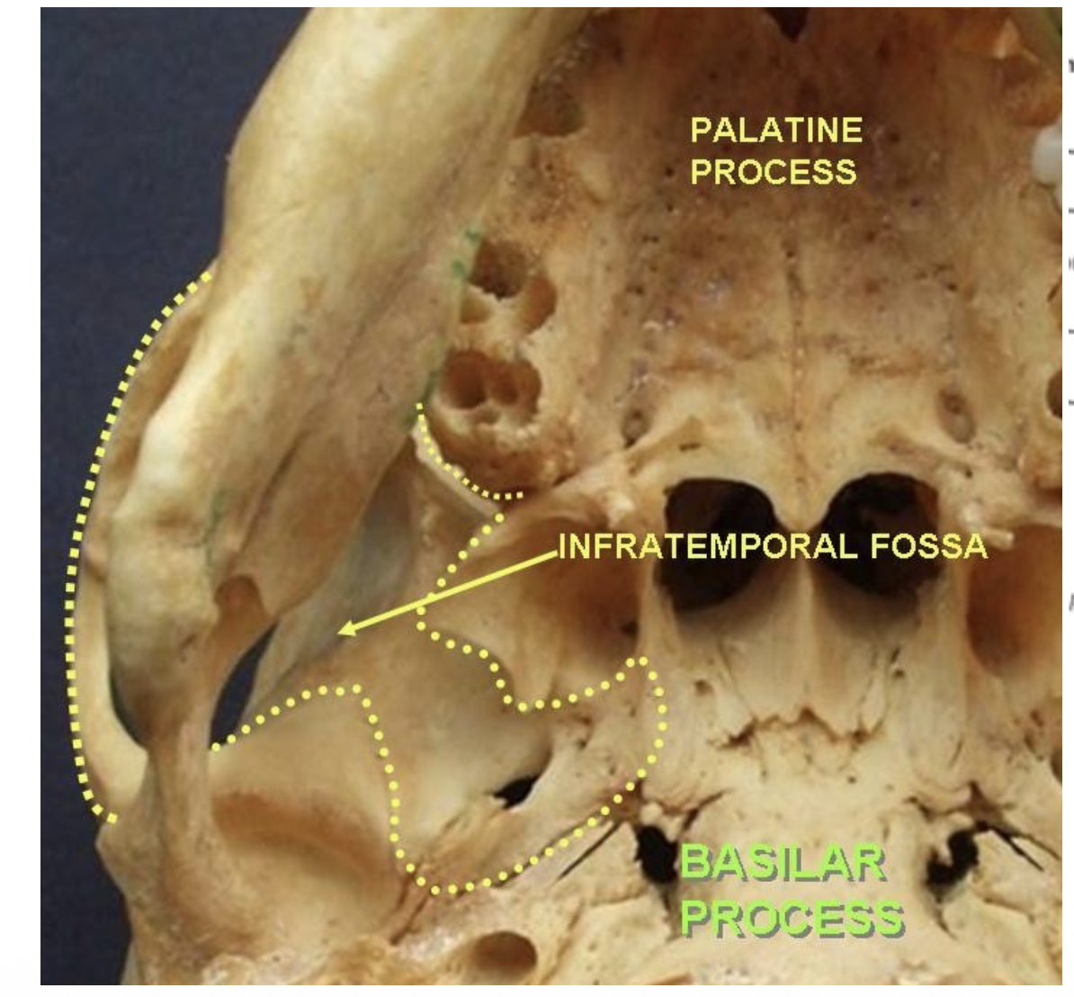 <p>ramus, coronoid process and mandibular notch of the mandible and medial surface of masseter muscle</p>