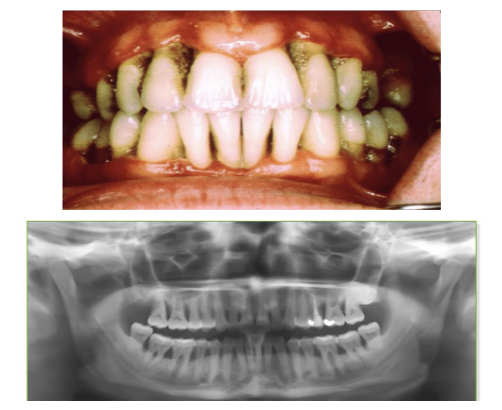 <p>inflammation, attachment loss and bone loss</p>
