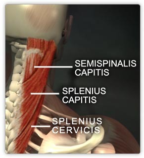 lateral superior nuchal line of occipital bone & mastoid process of temporal bone