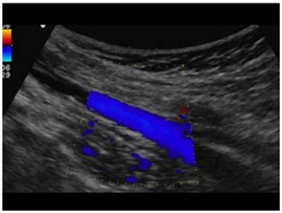<p>the direction of flow in this femoral vein is? and is it antegrade or retrograde flow?</p>
