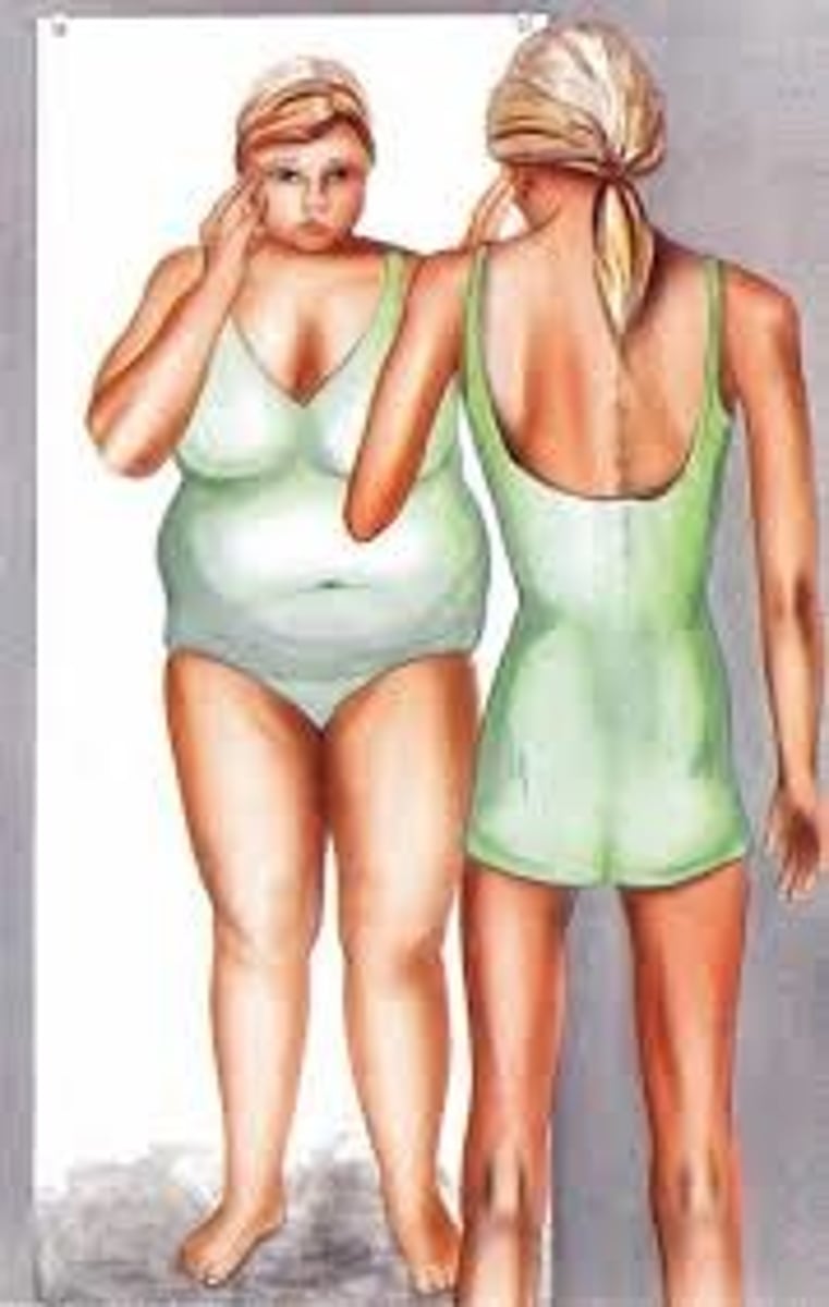 <p>An eating disorder in which an irrational fear of weight gain leads people to starve themselves</p>